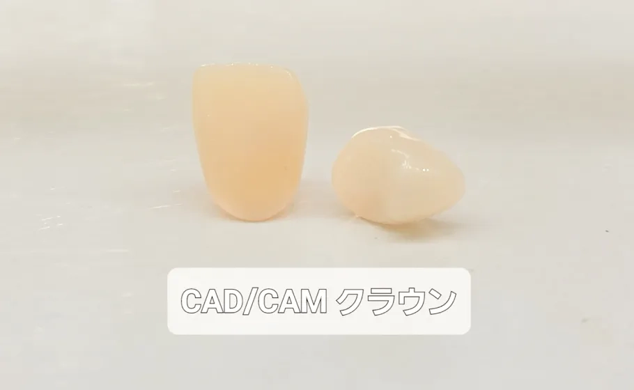 写真：CAD/CAM インレー、クラウン