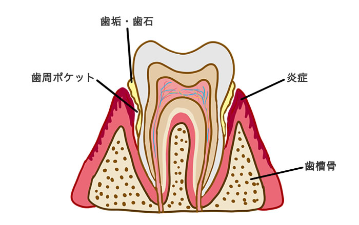 歯周病の歯