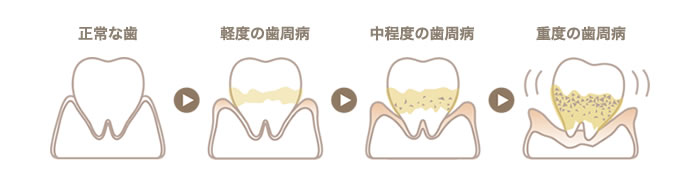 歯周病の進行