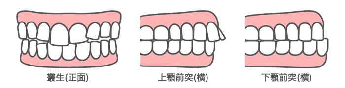 叢生・乱杭歯や上顎前突症など、そのほかの歯列不正