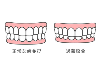 矯正治療の難易度が高い過蓋咬合（かがいこうごう）とは？