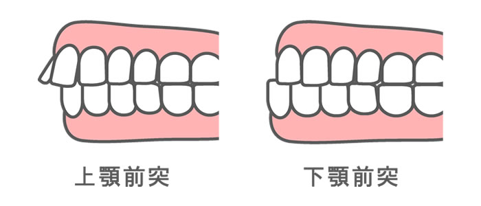 上顎と下顎の骨格の位置関係が良くない