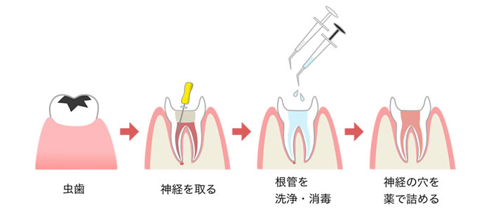 根管治療の流れ