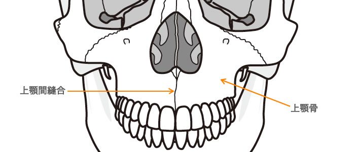 上顎間縫合