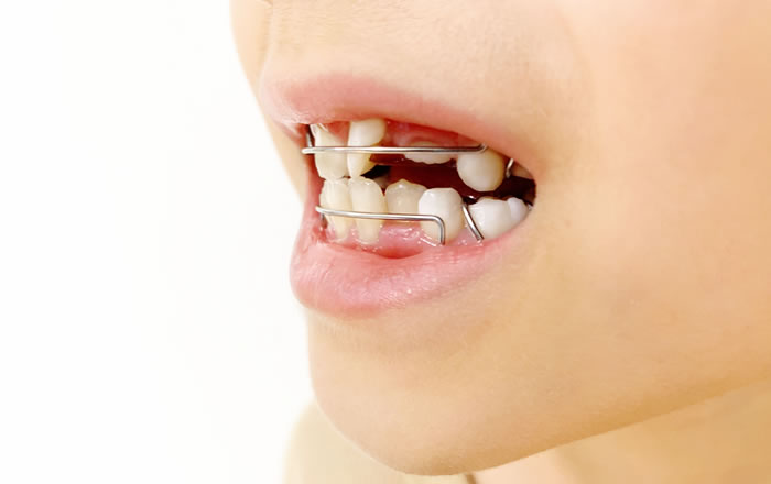 小児矯正と歯列拡大治療