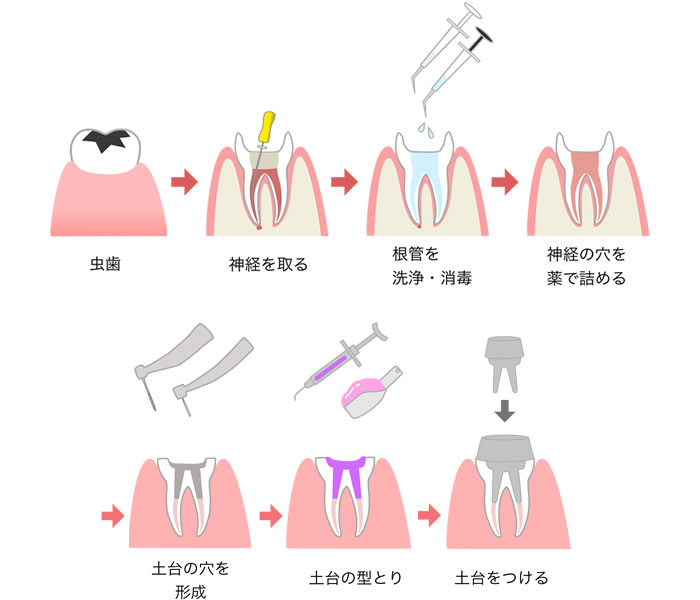 根管治療の流れ