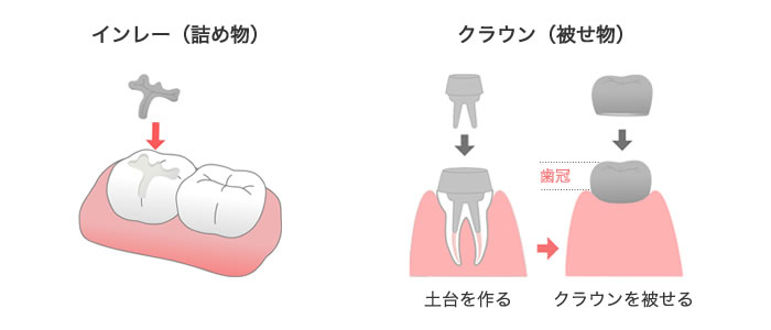 インレーとクラウン