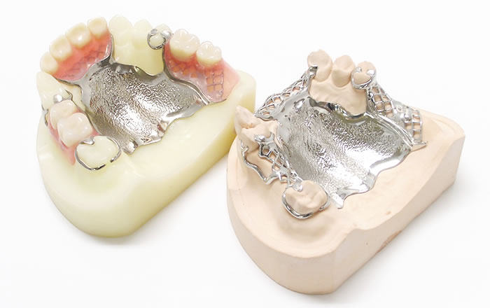 金属床義歯、メタルデンチャー