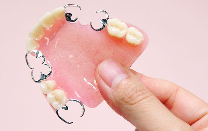 部分入れ歯の種類と特徴