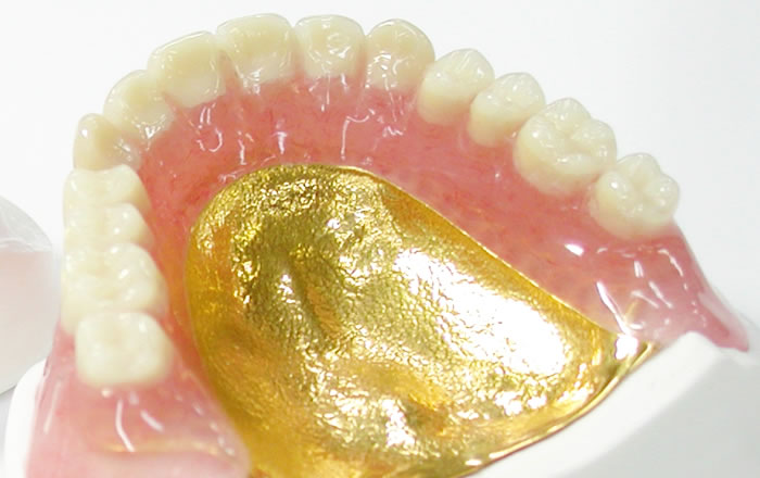 金属床義歯（きんぞくしょうぎし）、メタルデンチャーの総入れ歯