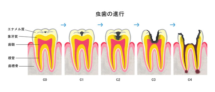 虫歯の進行,C0～C4