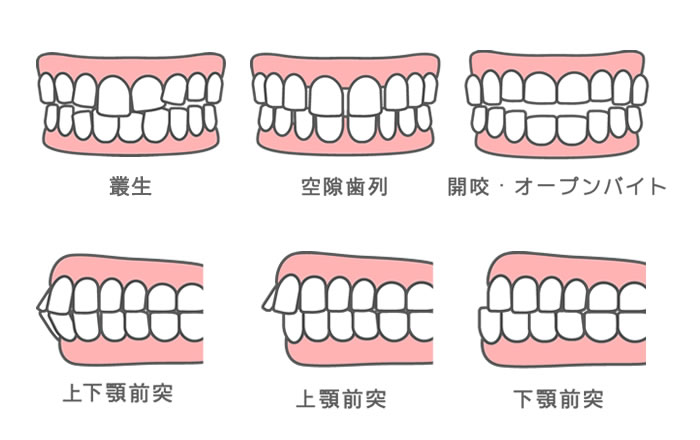 悪い歯並びの例