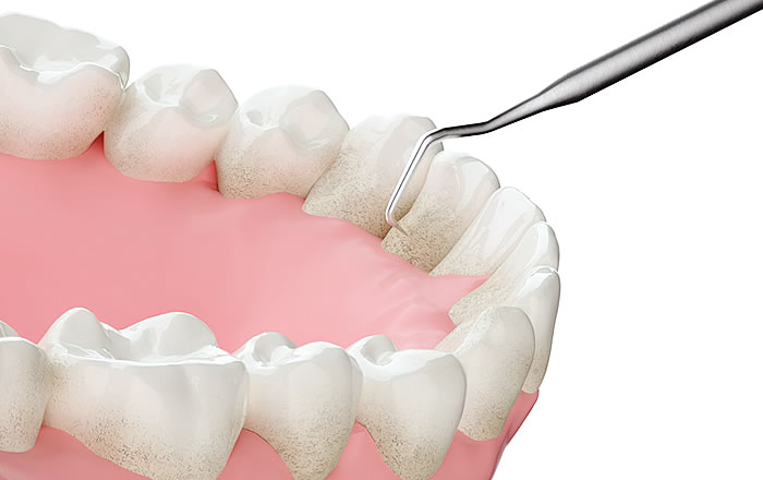 歯垢と歯石