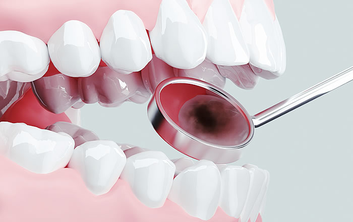 矯正治療による虫歯のリスク軽減