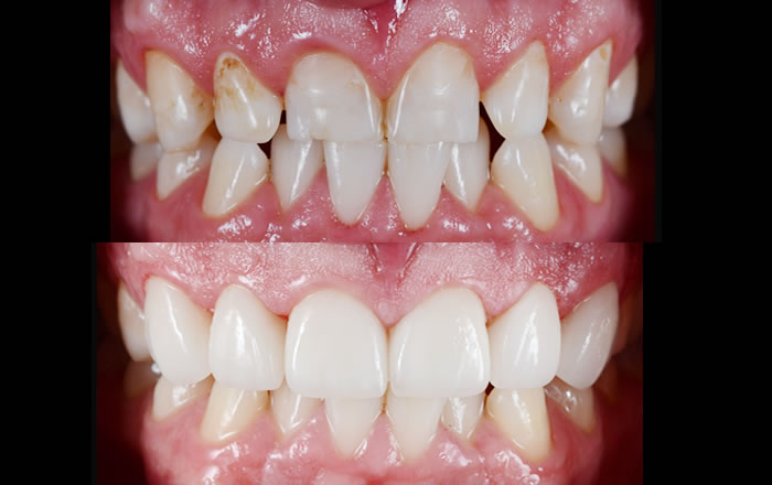 ポーセレンラミネートべニアは歯の形も調整できる