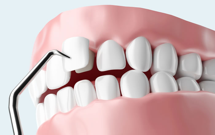 ポーセレン・ラミネートベニア（PLV）は、歯の表面にセラミックで作られた薄いカバー（シェルといいます）を接着する治療法です