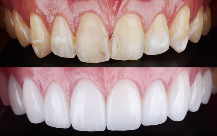 ポーセレン・ラミネートべニアは歯の色をきれいに合わせられ、本物の歯と同じような光沢感や透明感のある色になる