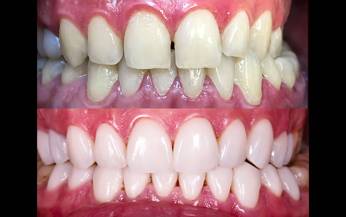前歯の隙間が気になる方はポーセレン・ラミネートベニアでの治療は有力な選択肢