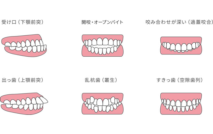 歯並びの状態が悪い（上顎前突,下顎前突,開咬,叢生,過蓋咬合,空隙歯列等）