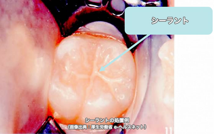 厚生労働省の発表によれば、シーラントを行った後の歯は、4年以上にわたり、約60%もの虫歯予防効果が確認されています。