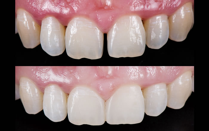 軽度の虫歯の治療（詰め物）や、すきっ歯などの歯並びの治療、また、歯がすり減ったり、欠けてしまった際の修復や歯の形状の整形、銀歯や金歯の箇所を、自然な歯の色に変えたいといった場合に、ダイレクトボンディングが用いられます
