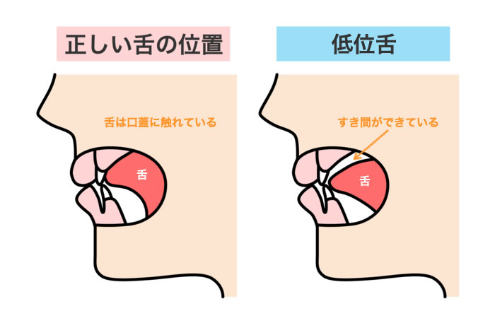 低位舌とは