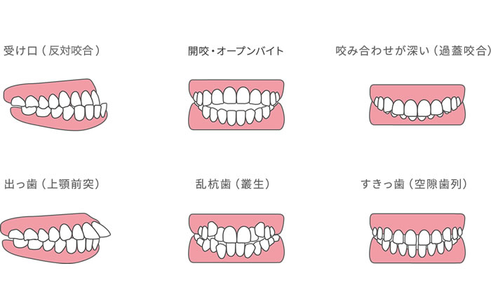 歯列不正の例～上顎前突,反対咬合,開咬,叢生,過蓋咬合,空隙歯列等
