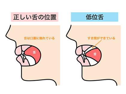 滑舌が悪い？それって低位舌（ていいぜつ）が原因かも