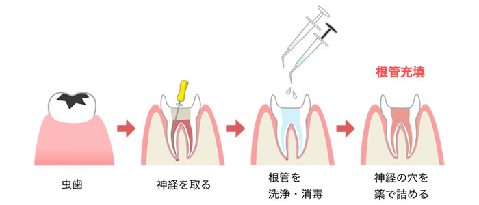 ガッタパーチャは根管治療の最終段階である根管充填に使います