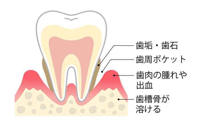 フィステルの原因～歯周病