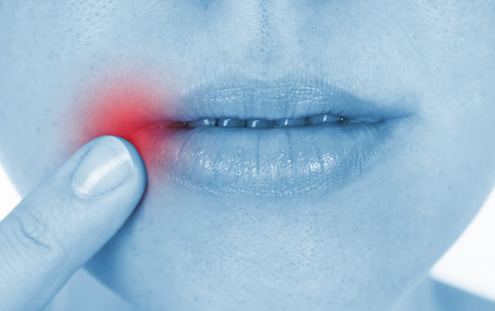 ウイルス性の口腔粘膜疾患の最も一般的な症状は水疱が唇の周り、歯茎や喉の奥に生じること