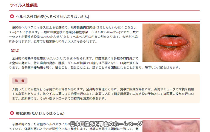 お口の中に症状が出るウイルス疾患の種類