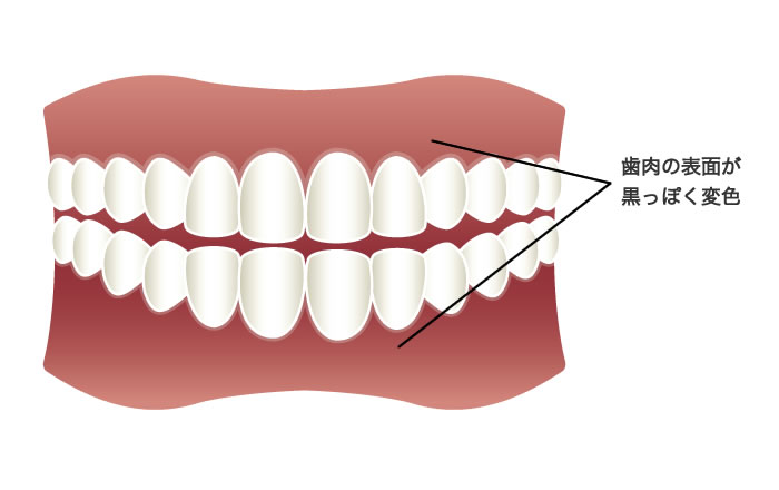 メラニン形成細胞により、黒っぽい色が歯肉の表面につく