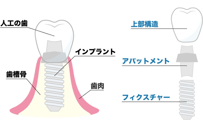 インプラントの構造