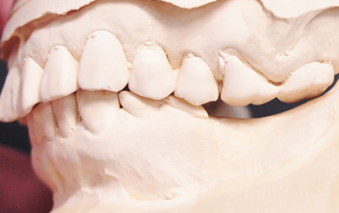 歯を失った状態を放置していると、歯がなくなった部分の両側の歯が倒れ込んできて、噛み合わせていた歯も伸びてきてしまいます（挺出）