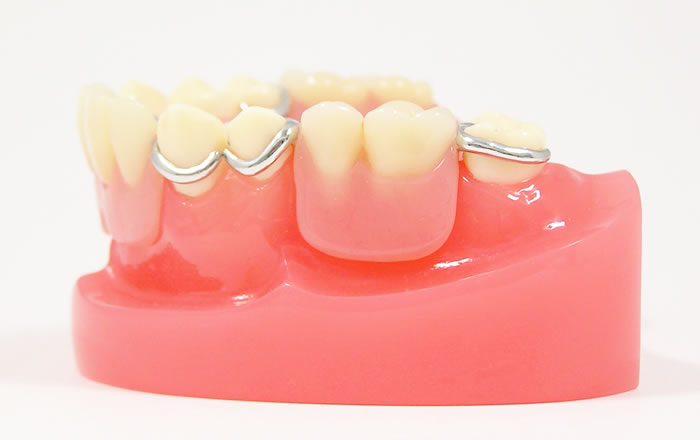 部分入れ歯には、歯に引っかけるクラスプという金具があります。このクラスプをかける歯には汚れが着きやすく、丁寧に歯磨きしないと、虫歯や歯周病にかかりやすくなります。