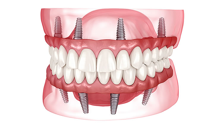 通常の入れ歯よりしっかり噛めるインプラント義歯