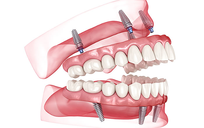 入れ歯を検討する際は、インプラント義歯も有力な選択肢に