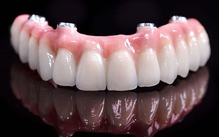 インプラント義歯のメリット：インプラントとしては低コストで侵襲（しんしゅう）が少ない