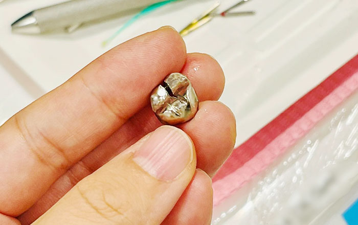 歯の被せ物や詰め物が外れてしまったらどうする?