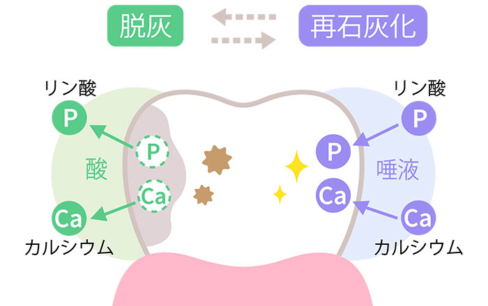 小さい虫歯を削らない3つの理由:予防と再石灰化で進行を止められるから