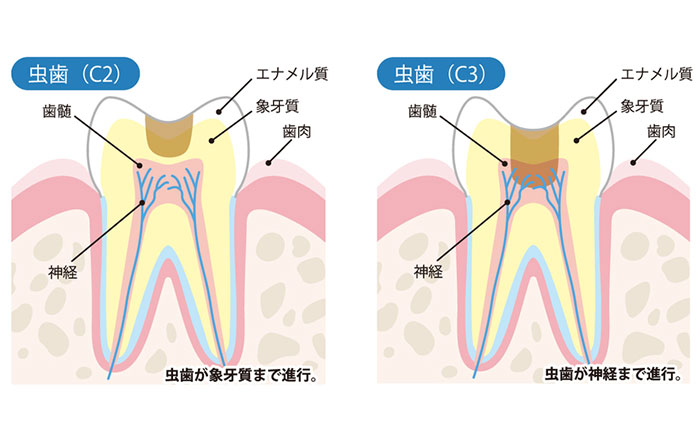 治療した方が良い虫歯:痛みや穴がある虫歯