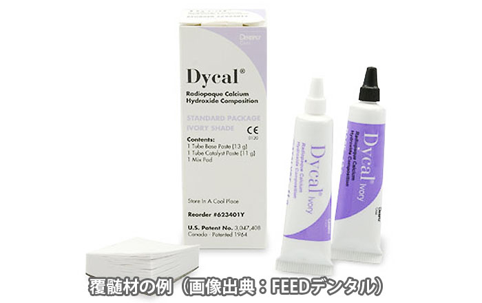 歯髄覆髄法（しずいふくずいほう）とは？