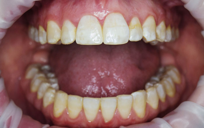 歯のフッ素症(斑状歯)