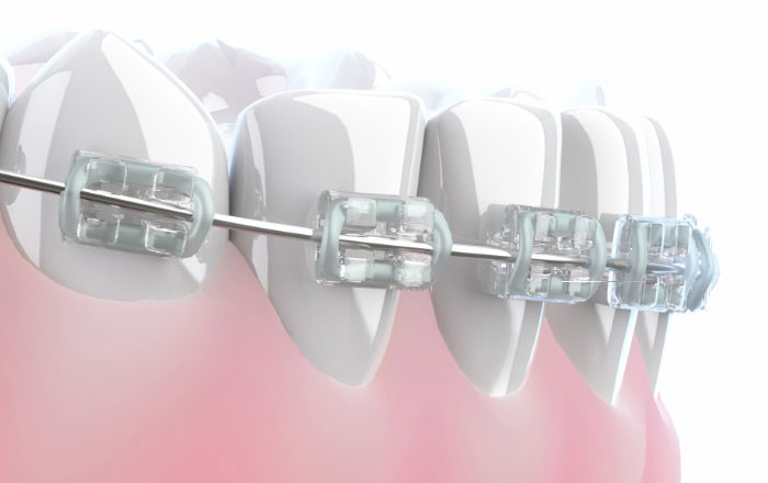 矯正治療中のワイヤーやブラケット、合わなくなった入れ歯などが唇の内側に当たることで、常に摩擦刺激が加わり、乾燥や荒れを悪化させることがあります