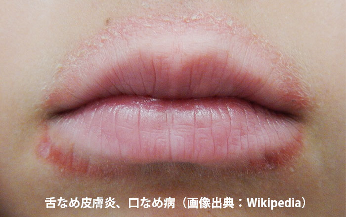 唇を舌で舐めることを繰り返すとに舌なめ皮膚炎、口なめ病になることも