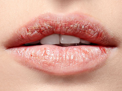 気になる唇の乾燥…ついつい舌で舐めていませんか?