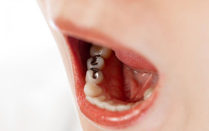 親になって後悔した歯とお口の問題:若い頃の虫歯放置と神経を取った歯の多さ