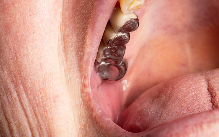 ガルバニー電流が発生しやすい組み合わせ:銀歯とアマルガム