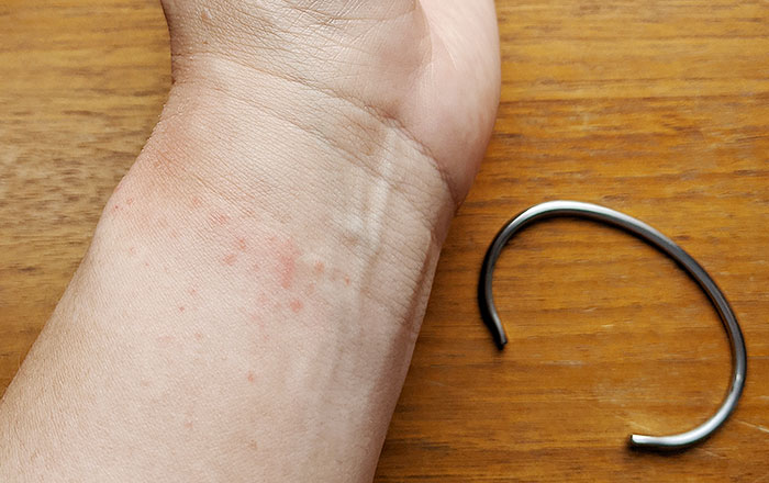 ガルバニー電流の症状:金属アレルギー